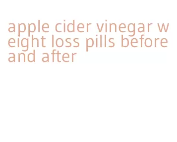 apple cider vinegar weight loss pills before and after